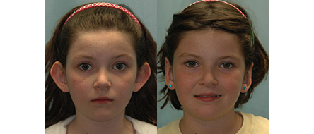Otoplasty Before and After Results