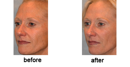 Pearl Fractional Laser Treatment Before & After