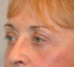 Eyelid (Blepharoplasty)