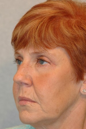 Eyelid (Blepharoplasty)