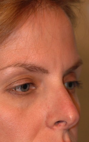 Eyelid (Blepharoplasty)