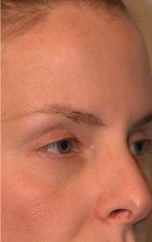 Eyelid (Blepharoplasty)