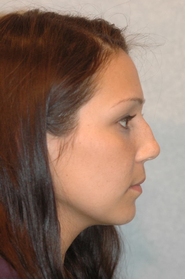 Rhinoplasty