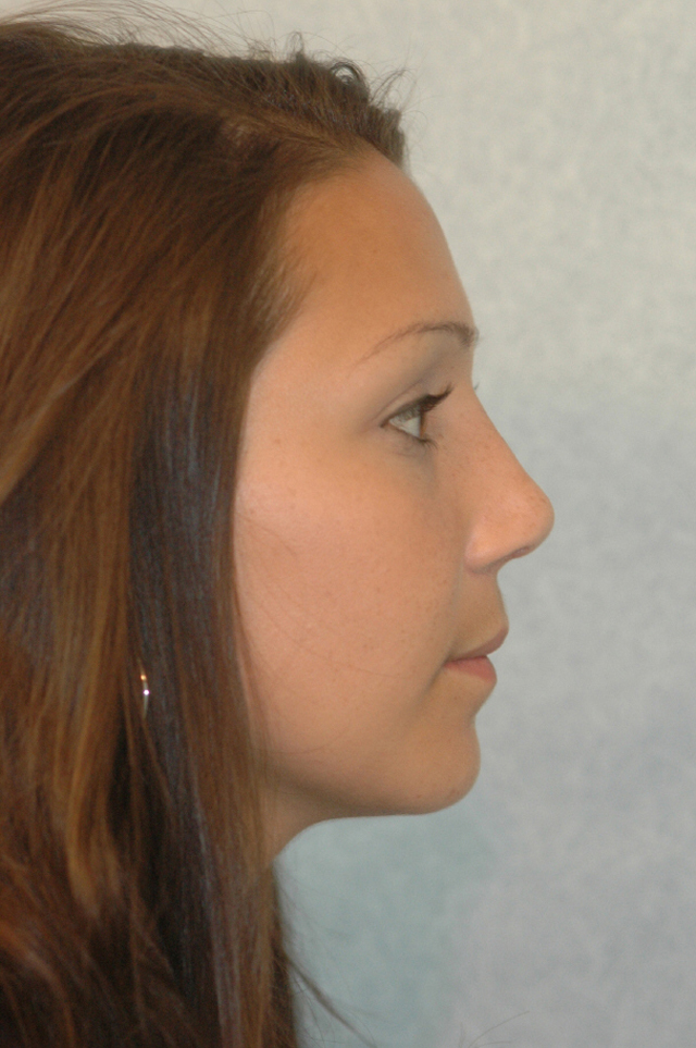 Rhinoplasty