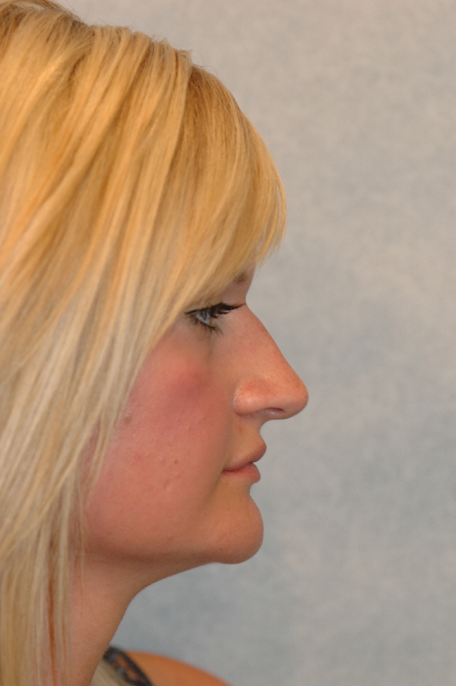 Rhinoplasty