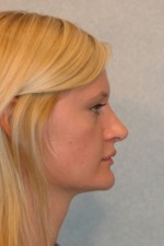 Rhinoplasty