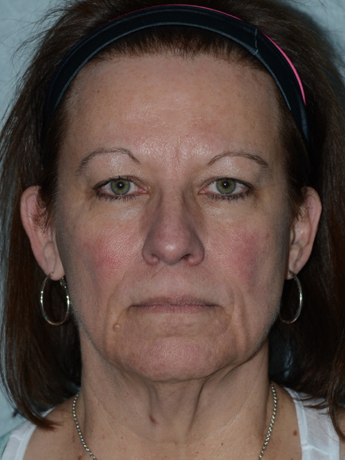 Browlift