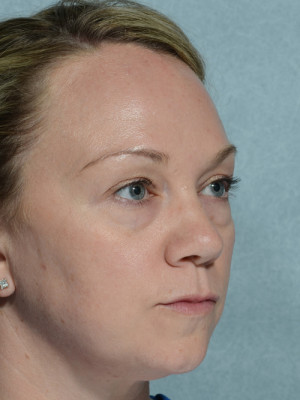 Eyelid (Blepharoplasty)