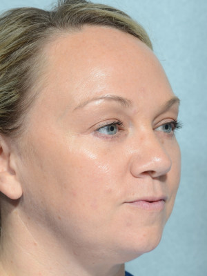 Eyelid (Blepharoplasty)