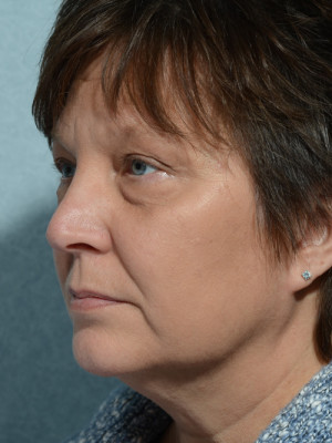 Eyelid (Blepharoplasty)