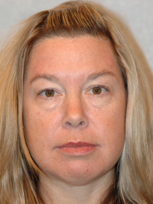 Eyelid (Blepharoplasty)