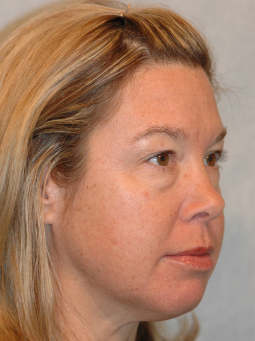 Eyelid (Blepharoplasty)