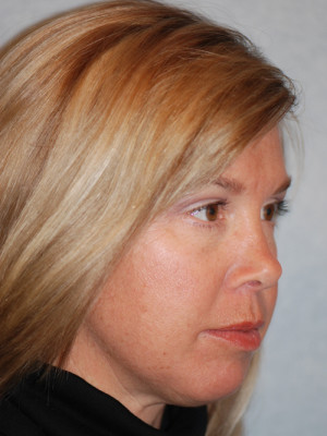 Eyelid (Blepharoplasty)