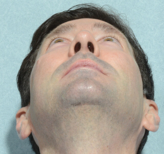 Rhinoplasty