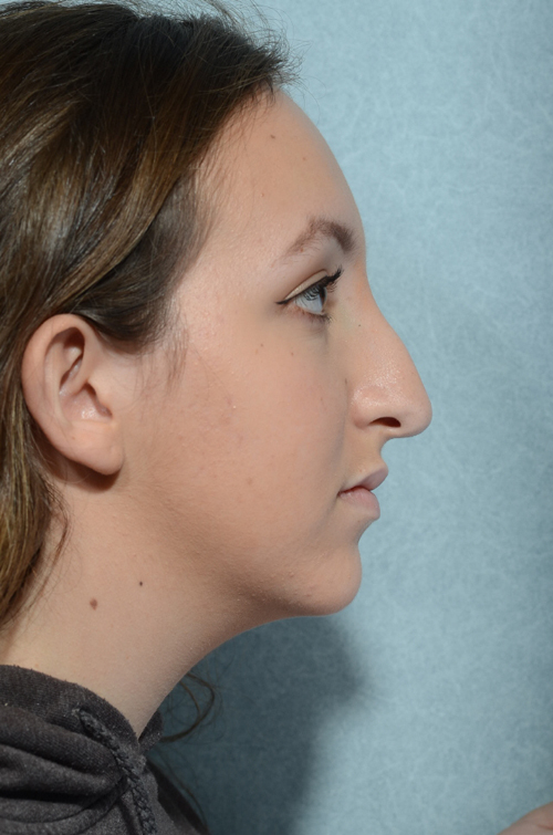 Rhinoplasty