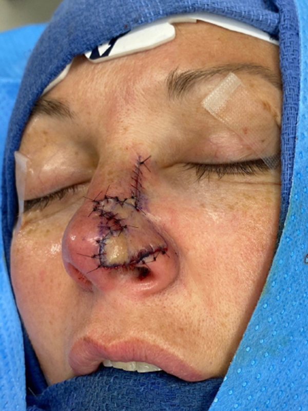 Skin Cancer Reconstruction