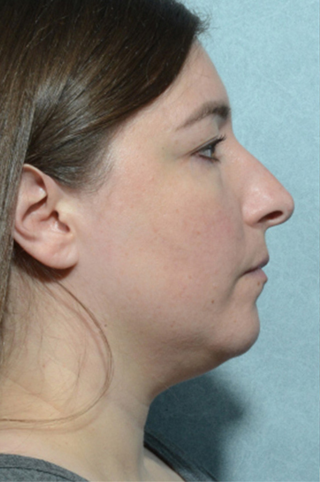 Rhinoplasty