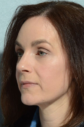 Eyelid (Blepharoplasty)