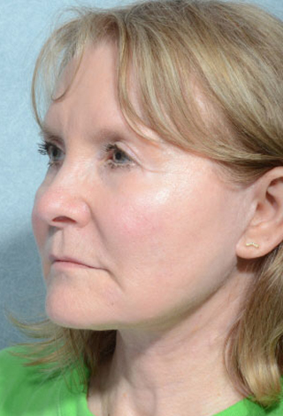Facelift