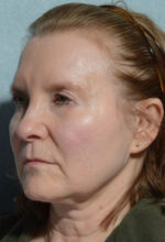 Facelift