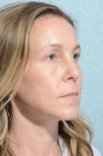 Eyelid (Blepharoplasty)