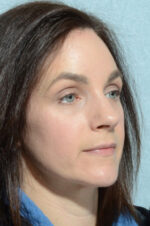 Eyelid (Blepharoplasty)