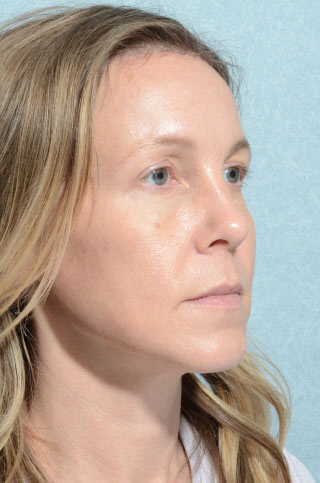 Eyelid (Blepharoplasty)