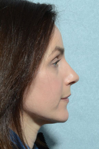 Eyelid (Blepharoplasty)