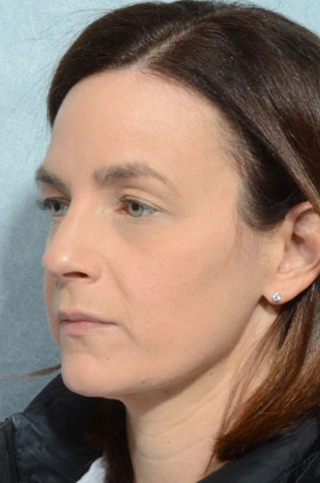 Eyelid (Blepharoplasty)