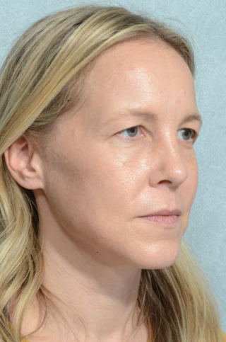 Eyelid (Blepharoplasty)