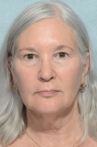 Eyelid (Blepharoplasty)