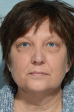 Eyelid (Blepharoplasty)