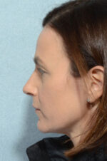 Eyelid (Blepharoplasty)