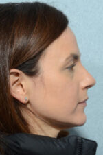 Eyelid (Blepharoplasty)