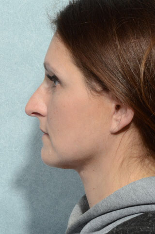 Browlift