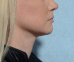 Chin Augmentation