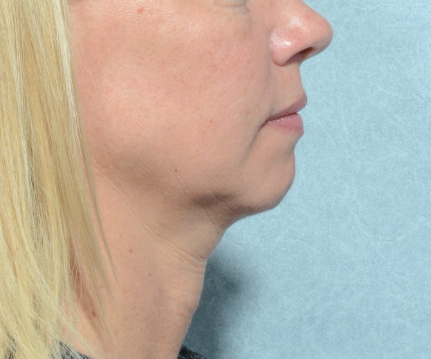 Chin Augmentation