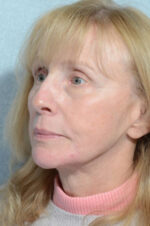 Facelift