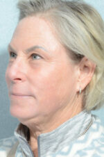 Facelift