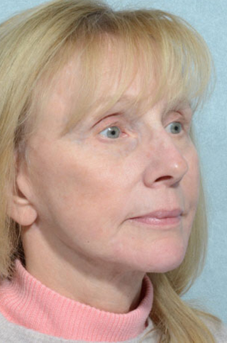 Facelift