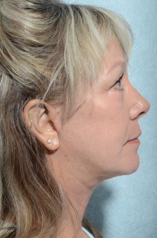 Facelift