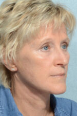 Facelift