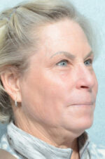 Facelift