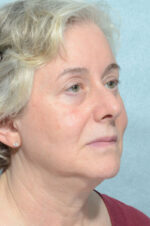 Facelift