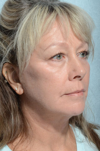 Facelift