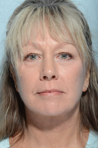 Facelift