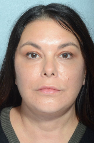 Facelift