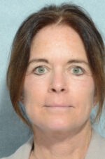 Facelift