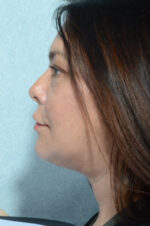 Facelift