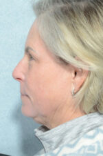 Facelift